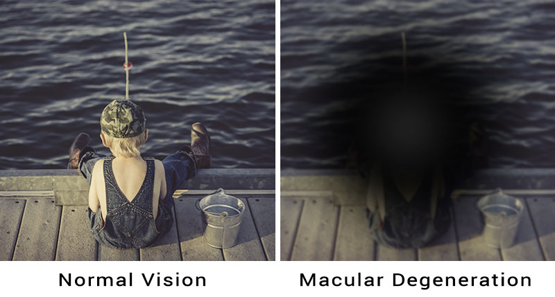 macular degeneration treatable adult eyecare local eye doctor near you